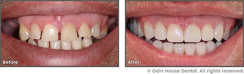 Patient's before and after smile makeover results