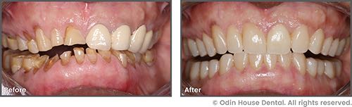 Patient's before and after smile makeover results